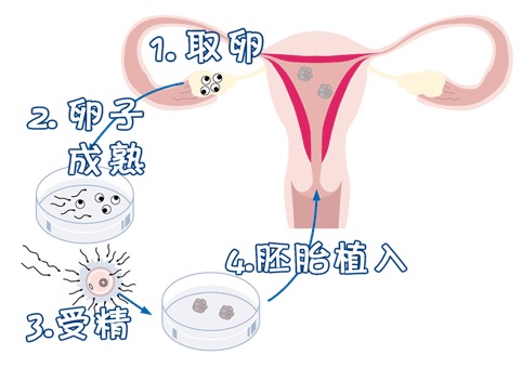 妇科微创